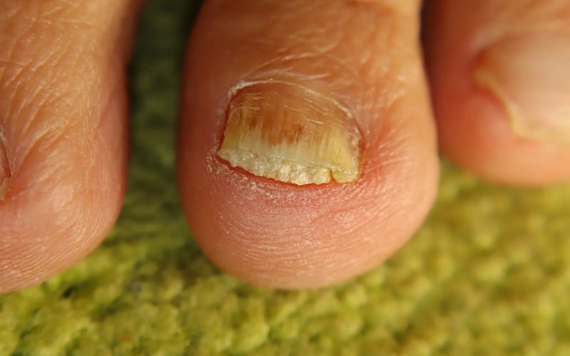 Verrucae & Warts